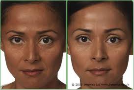 nasoloabial smile line fillers Mendham New Jersey